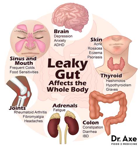 symptoms of leaky gut